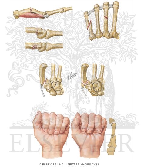 Watermarked preview of unlabeled image: Fracture of the Hand