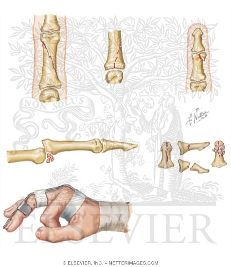 Watermarked preview of unlabeled image: Fracture of the Hand