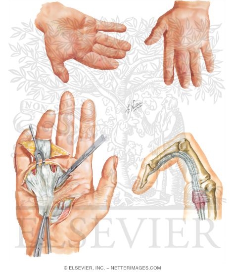 Disorders of the Hand