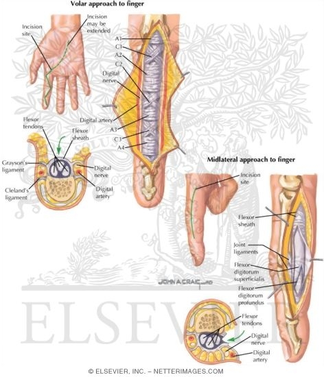 Watermarked preview of labeled image: Surgical Approach to Finger