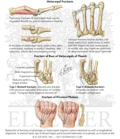 Fracture of the Hand