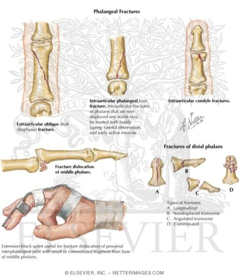 Watermarked preview of labeled image: Fracture of the Hand