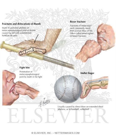 Watermarked preview of labeled image: Injuries of the Hand