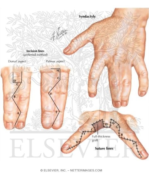 Pediatric Disorders of the Hand