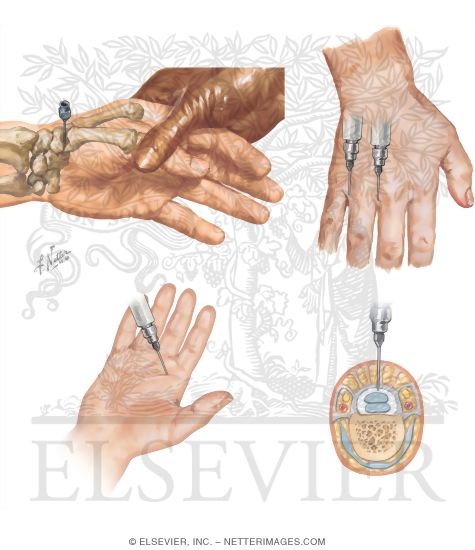 Watermarked preview of unlabeled image: Minor Procedures of the Hand