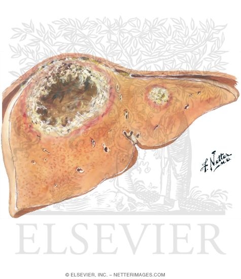 Amebic Liver Abscess