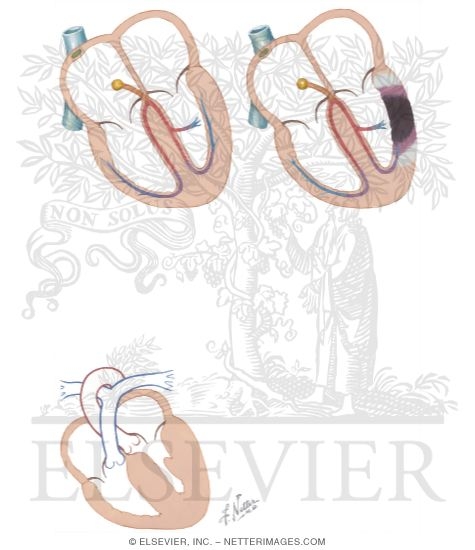 Watermarked preview of unlabeled image: Q Waves: Differential Diagnosis