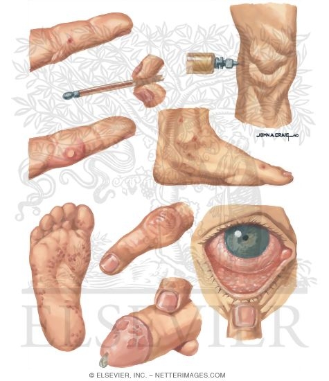 Sexually Transmitted Diseases: Lesions in Diseminated Gonorrhea and Reiter's Disease