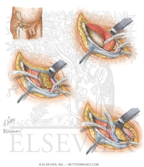 Watermarked preview of unlabeled image: Surgical Approaches to the Pelvis