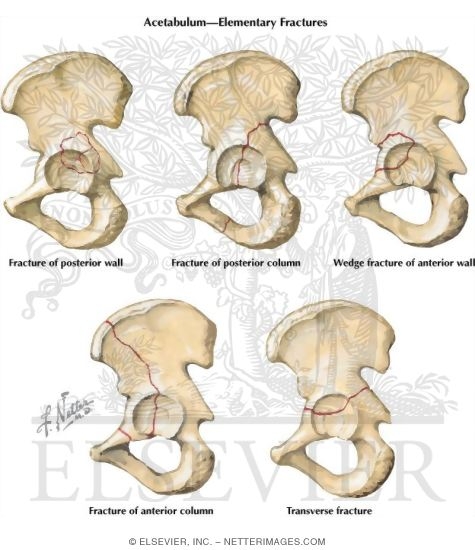 Watermarked preview of labeled image: Pelvic Fractures