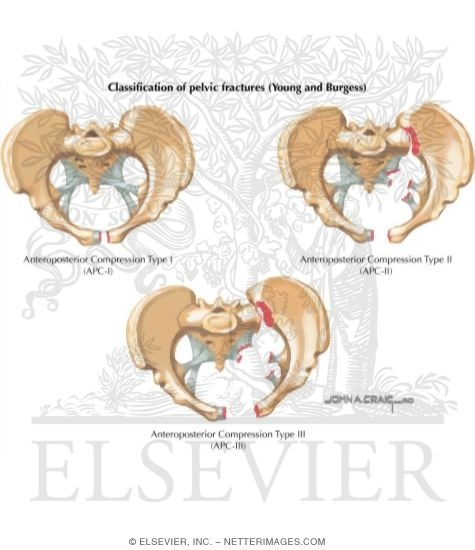 Watermarked preview of labeled image: Trauma of Pelvis