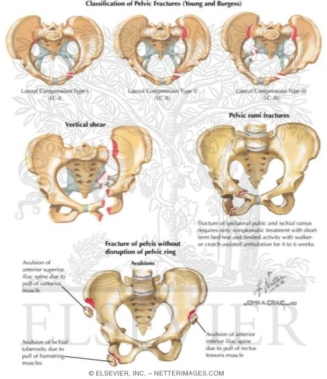 Watermarked preview of labeled image: Trauma of the Pelvis