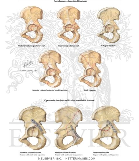 Watermarked preview of labeled image: Trauma of the Pelvis