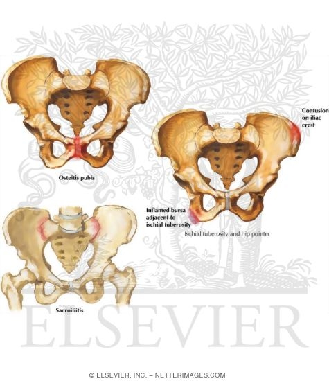 Watermarked preview of labeled image: Disorders of the Pelvis