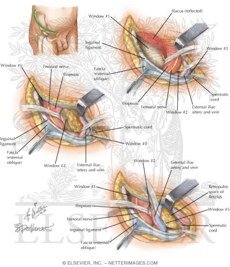Watermarked preview of labeled image: Surgical Approaches to the Pelvis