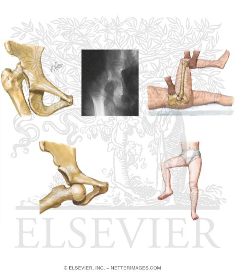 Watermarked preview of unlabeled image: Trauma of the Thigh and Hip