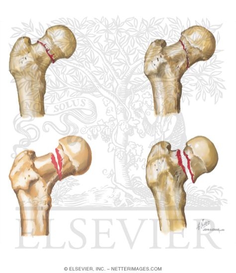 Watermarked preview of unlabeled image: Trauma of the Thigh and Hip
