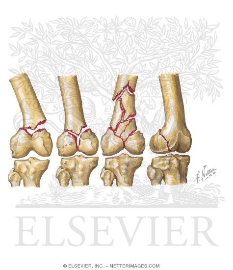 Watermarked preview of unlabeled image: Trauma of the Thigh and Hip