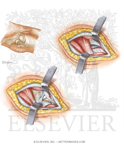 Watermarked preview of unlabeled image: Surgical Approaches to the Thigh and Hip
