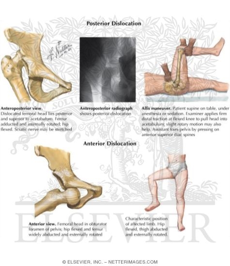Watermarked preview of labeled image: Trauma of the Thigh and Hip