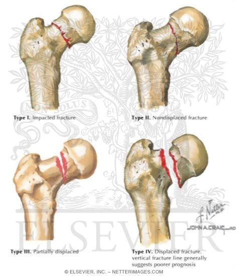 Watermarked preview of labeled image: Trauma of the Thigh and Hip
