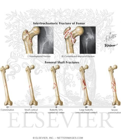 Watermarked preview of labeled image: Trauma of the Thigh and Hip