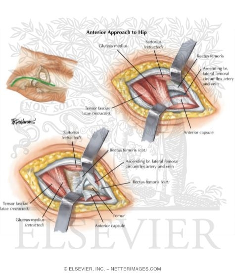 Watermarked preview of labeled image: Surgical Approaches to the Thigh and Hip