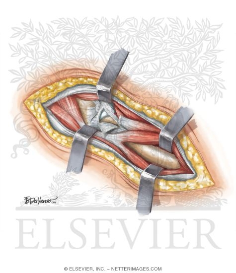 Watermarked preview of unlabeled image: Surgical Approaches to the Thigh and Hip