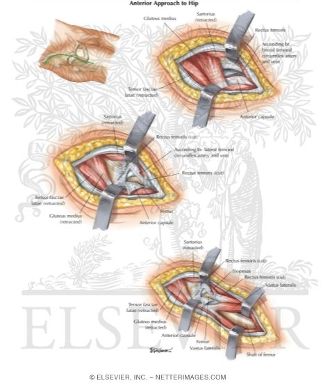 Watermarked preview of labeled image: Surgical Approaches to the Thigh and Hip