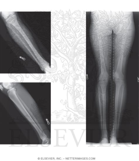 Radiology of the Leg and Knee