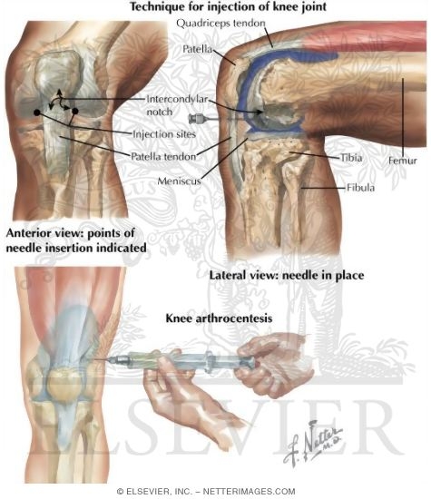 Watermarked preview of labeled image: Minor Procedures of the Leg and Knee