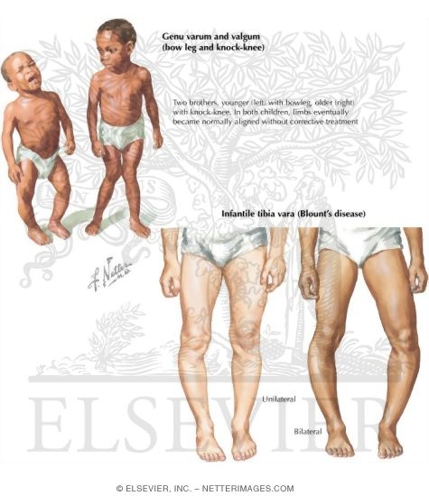 Pediatric Disorders of the Leg and Knee
