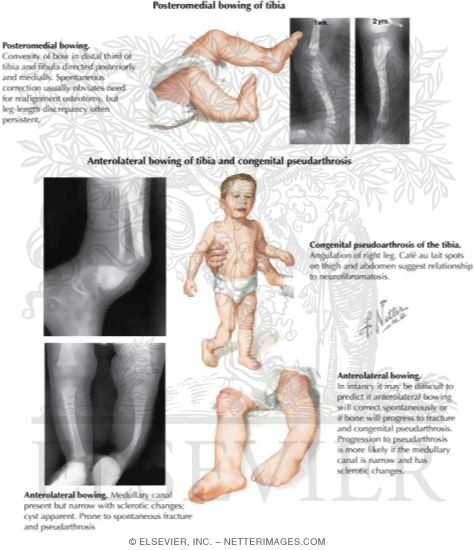 Watermarked preview of labeled image: Pediatric Disorders of the Leg and Knee