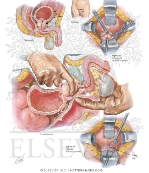 Watermarked preview of labeled image: Surgical Approaches II - Retropubic
