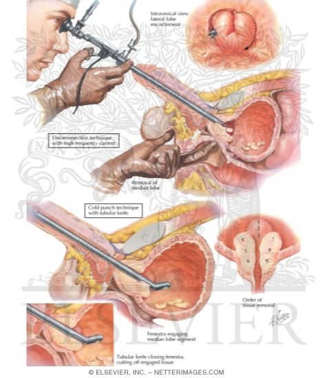 Watermarked preview of labeled image: Surgical Approaches IV - Transurethral