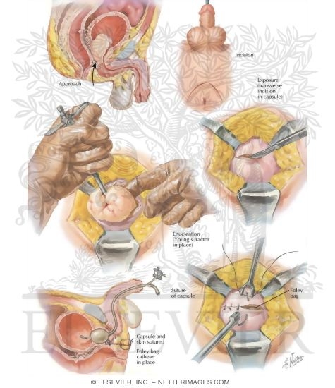 Watermarked preview of labeled image: Surgical Approaches III - Perineal