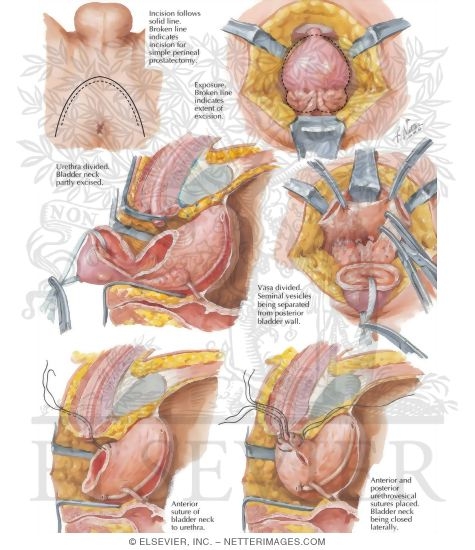 Thesis radical prostatectomy image
