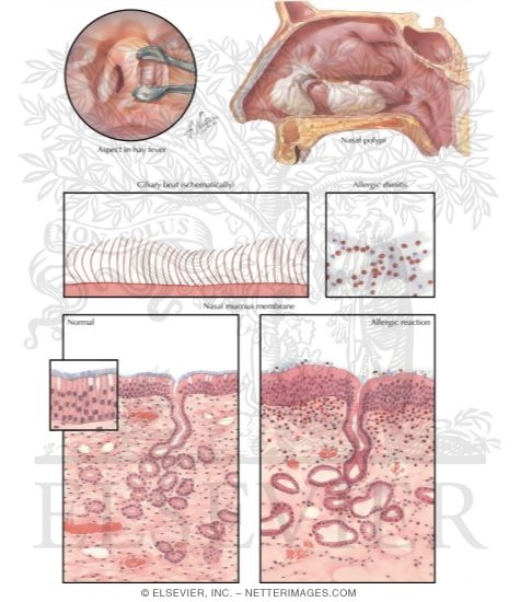 Watermarked preview of labeled image: Acute And Chronic Nasal Allergy
