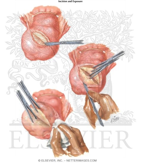 Watermarked preview of labeled image: Myomectomy In Treatment Of Infertility