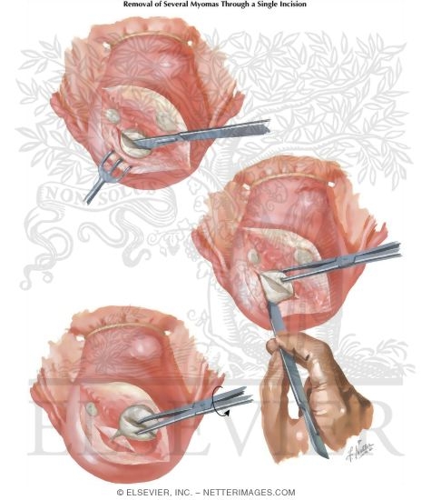 Watermarked preview of labeled image: Myomectomy In Treatment Of Infertility