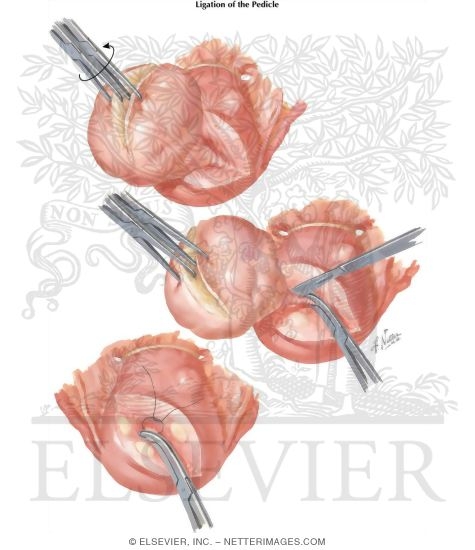 Watermarked preview of labeled image: Myomectomy In Treatment Of Infertility