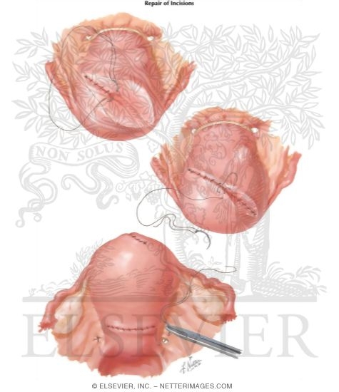 Watermarked preview of labeled image: Myomectomy In Treatment Of Infertility