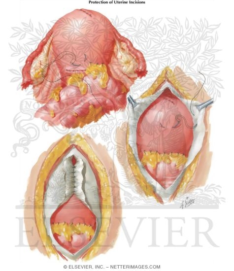 Watermarked preview of labeled image: Myomectomy In Treatment Of Infertility