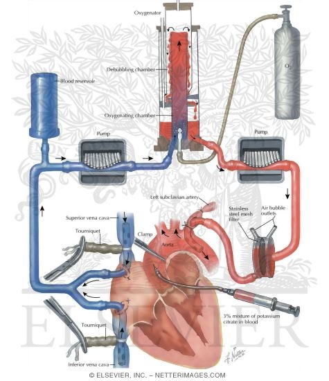 Heart-Lung Machine