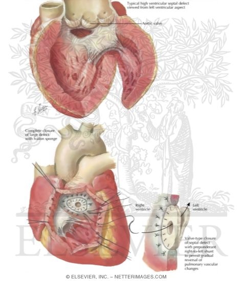 Watermarked preview of labeled image: Ventricular Septal Defect