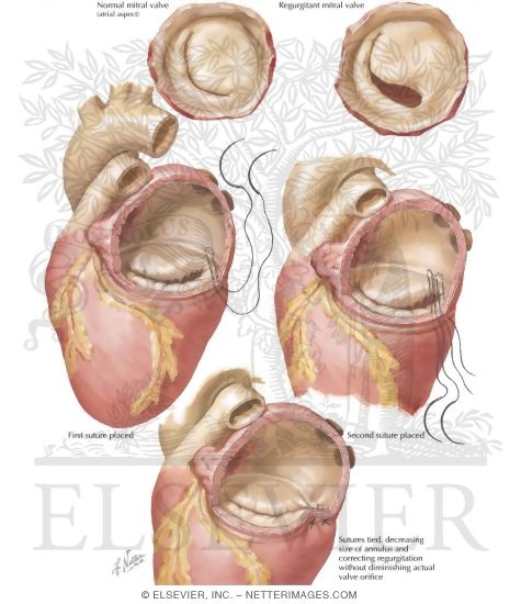 Mitral Insufficiency