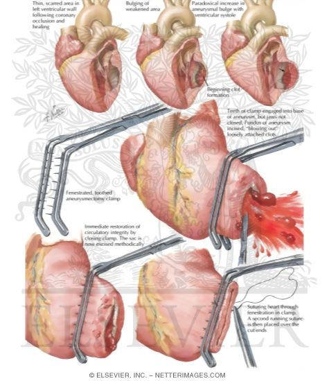 Watermarked preview of labeled image: Ventricular Aneurysm