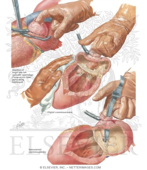 Watermarked preview of labeled image: Left-Sided Approach To Mitral Stenosis