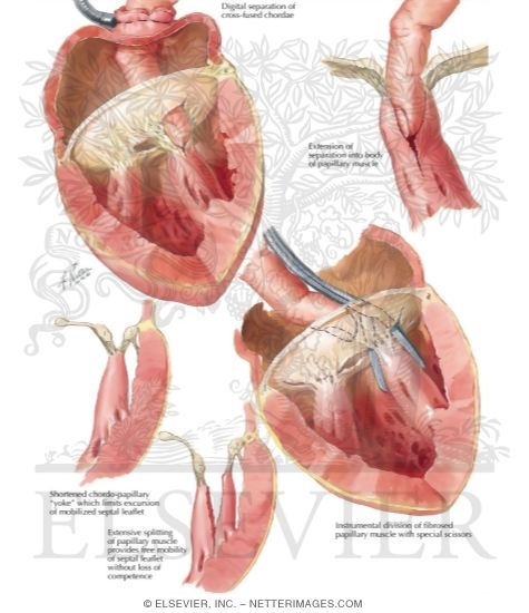 Watermarked preview of labeled image: Subvalvular Stenosis