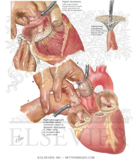 Watermarked preview of labeled image: Tricuspid Stenosis